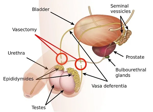 Vasectomy diagram