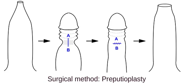Preputioplasty